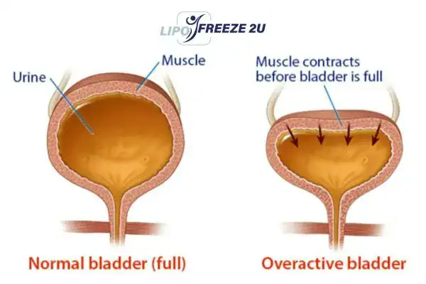 diagram of overactive bladder treatment Bexhill