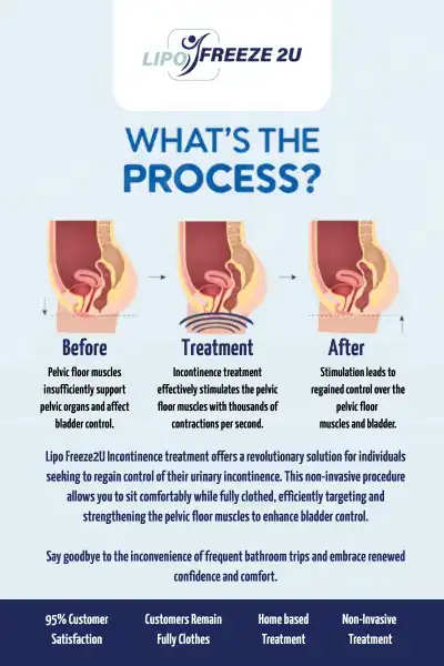 Diagram of how incontinence treatment Bexhill works.