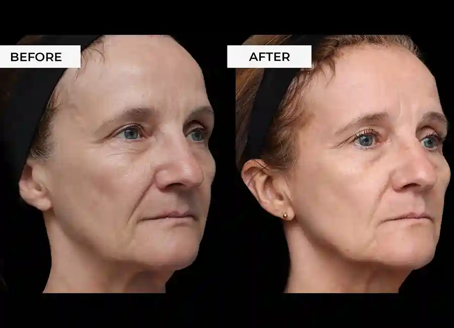 How Many RF Microneedling Sessions Will You Need to See a Difference Bexhill?