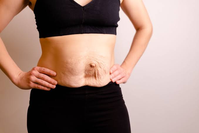 Is Surgery Really the Only Way to Repair Diastasis Recti Bexhill?