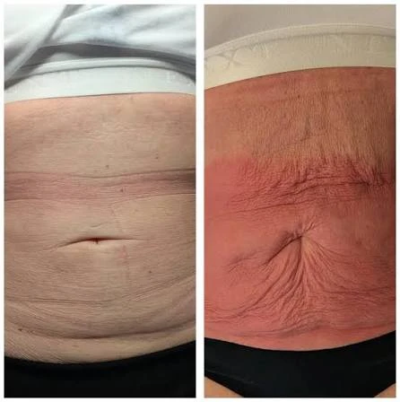How Does RF Microneedling Improve Crepey, Thin and Uneven Skin Texture Bexhill?