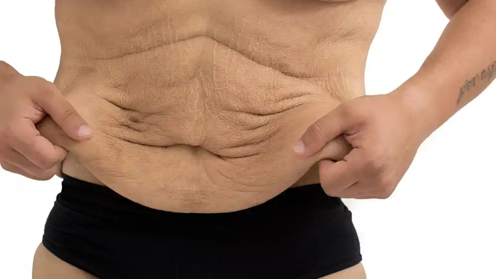 RF Microneedling for Loose Skin: How Can It Help Tighten and Reshape the Skin Bexhill?
